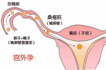 宫外孕试纸颜色会加深吗