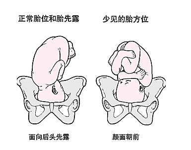 分娩方式主要由胎儿的位置决定
