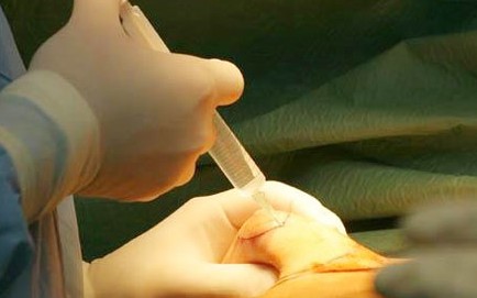 详述剖宫产手术前的准备工作分娩方式