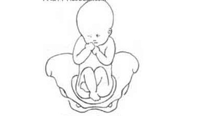 胎儿臀位如何选择分娩方式分娩方式