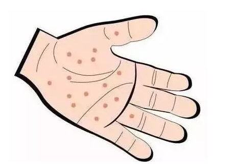手部湿疹怎么治疗能去根？用什么药膏效果好