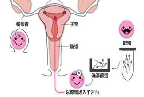 宫寒不孕可以人工受精吗