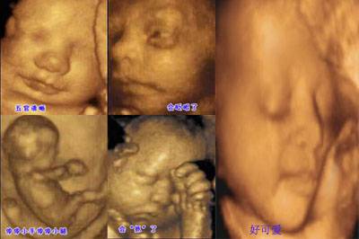 【怀孕23周】怀孕23周胎儿彩超图及胎动注意事项