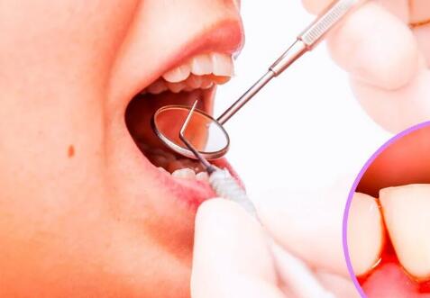 治疗牙龈炎的特效偏方