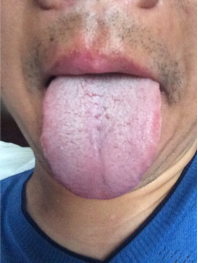老年人舌苔发白是什么原因呢？舌苔发白是怎么回事？
