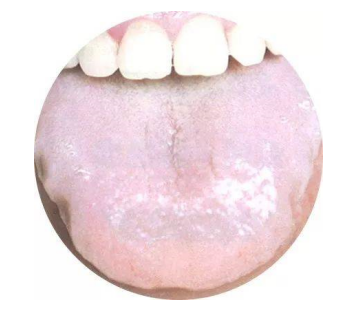 舌头两边有齿痕是什么原因？用昆中药参苓健脾胃颗粒治对吗？
