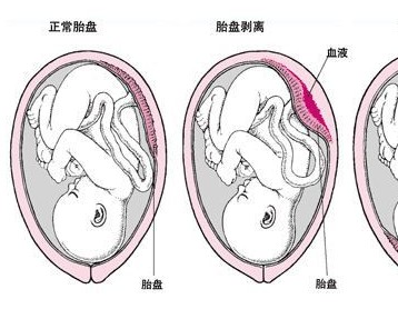 什么是前置胎盘以及它的种类孕妇疾病