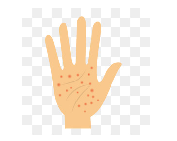 手指湿疹怎么治疗好得快?手部湿疹抹什么药膏好使