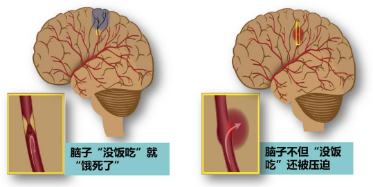 脑栓通胶囊功效与作用 脑栓通胶囊说明书了解清楚再吃！