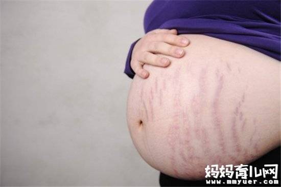 妊娠纹可以预防的吗 孕妈们不得不知预防妊娠纹的方法