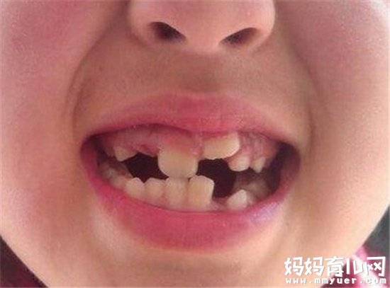 宝宝在多大的时候开始换牙 孩子换牙期要注意这些