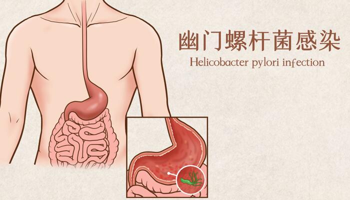 辣椒素可抑制幽门螺旋杆菌生长 可预防多种胃癌的产生